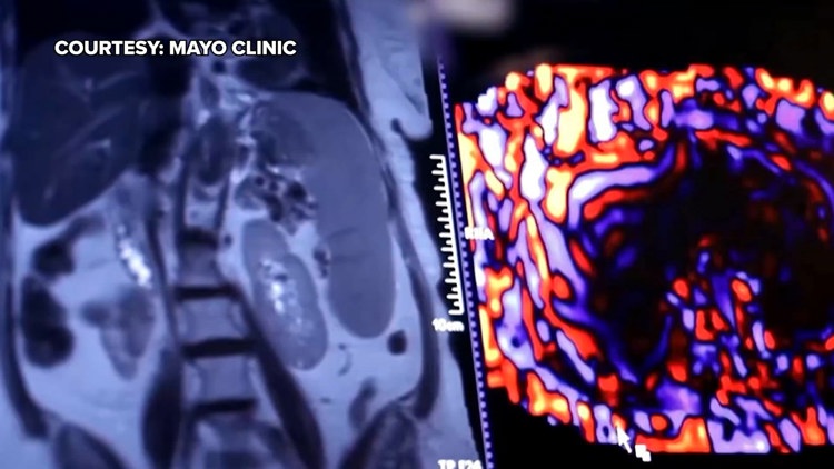 Healthy SA: Battling liver cancer, a disease which often has no symptoms early on — KENS 5 (San Antonio), Grafton Health news